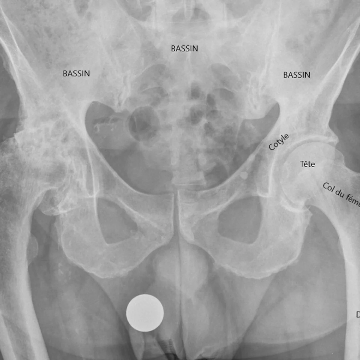 Les fractures du col fémoral