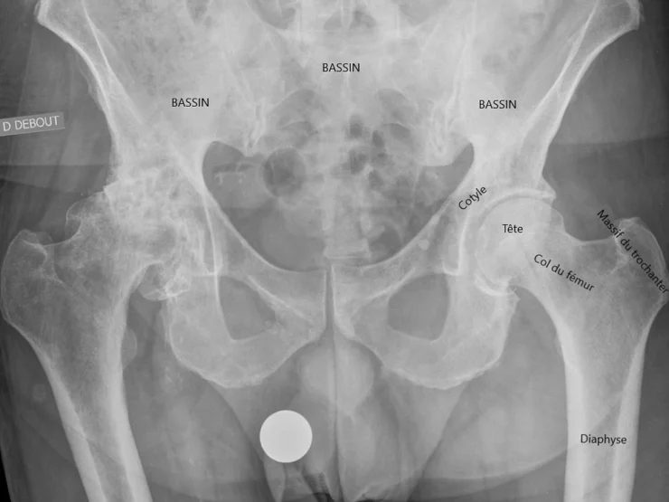 Les fractures du col fémoral
