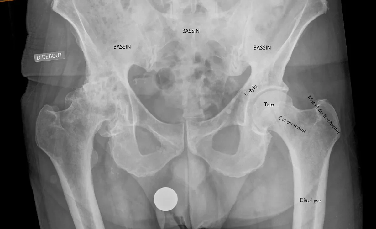 Les fractures du col fémoral