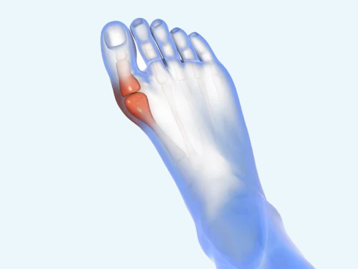 Hallux Valgus