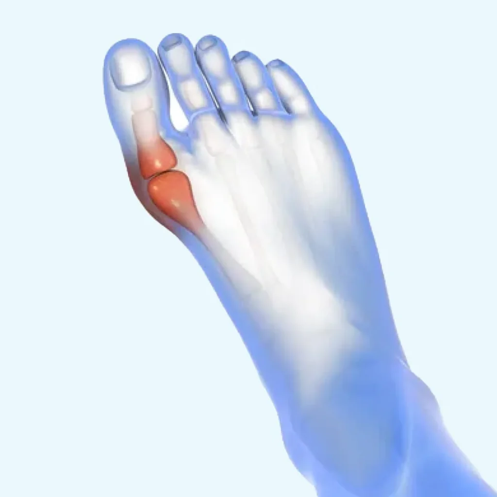 Hallux Valgus