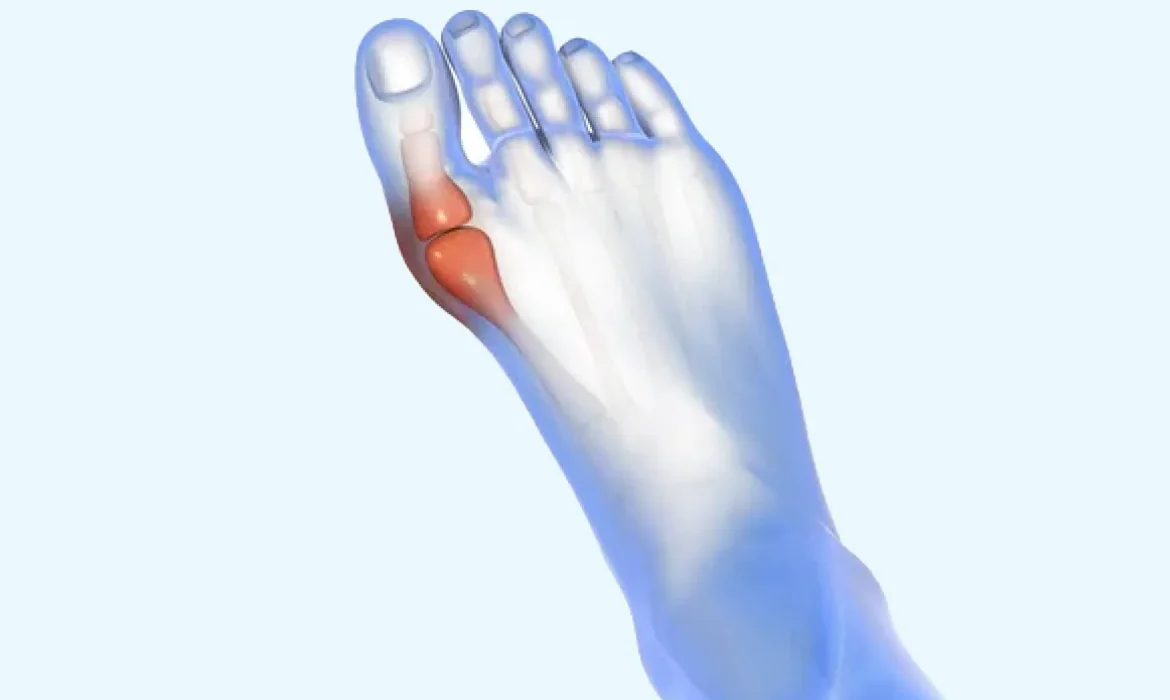 Hallux Valgus