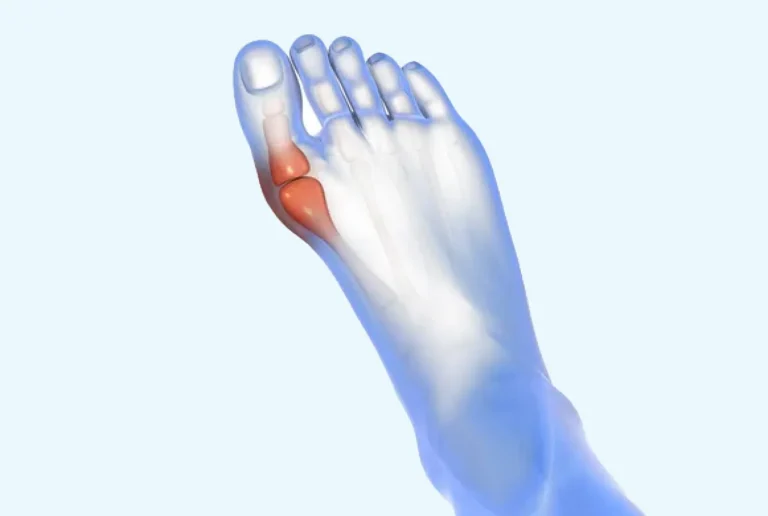 L’HALLUX VALGUS