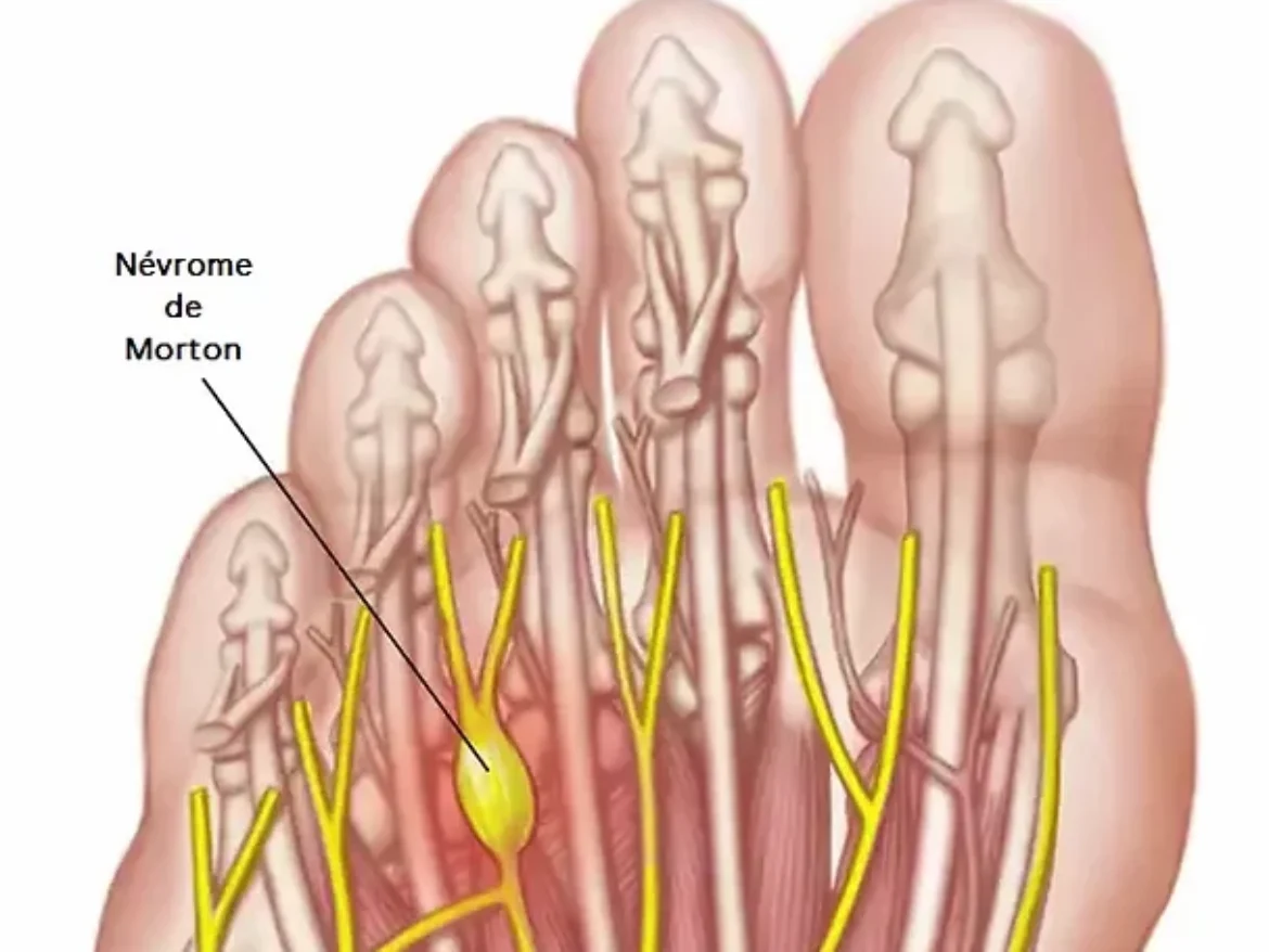 ds00468_im00333_mcdc7_mortons_neuromathu_jpg_heic