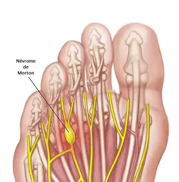ds00468_im00333_mcdc7_mortons_neuromathu_jpg_heic