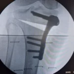 KNEE OSTEOTOMIES