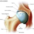TOTAL HIP REPLACEMENT