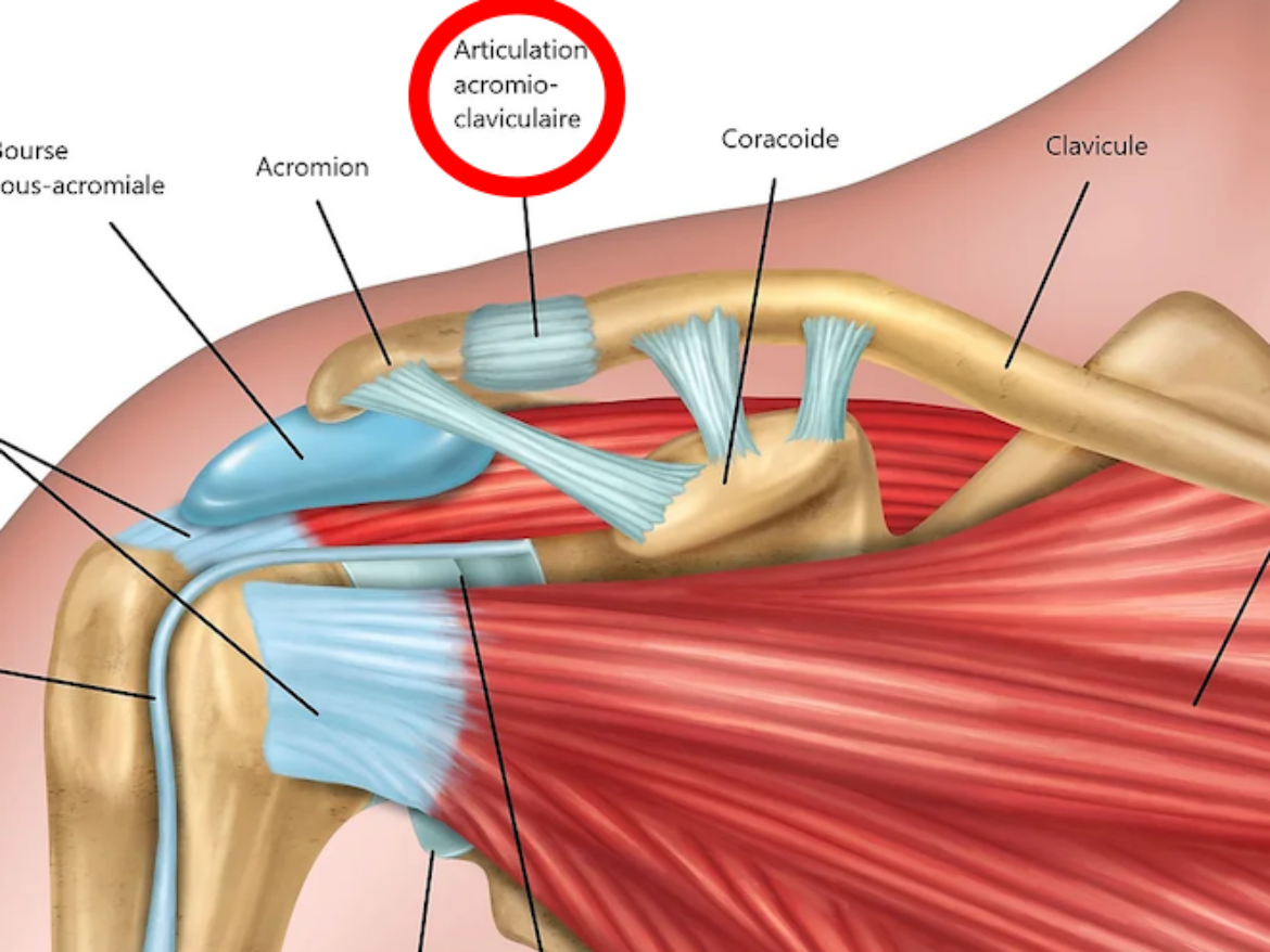 LUXATION ACROMIOCLAVICULAIRE