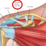 LUXATION ACROMIOCLAVICULAIRE