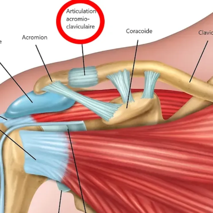 ACROMIOCLAVICULAR DISLOCATION