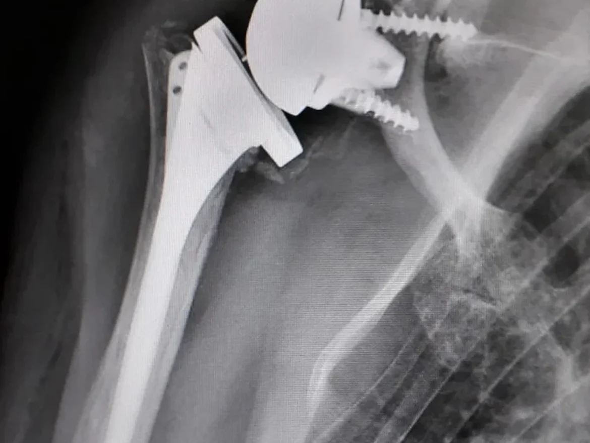 PROTHÈSE DE L&rsquo;ÉPAULE