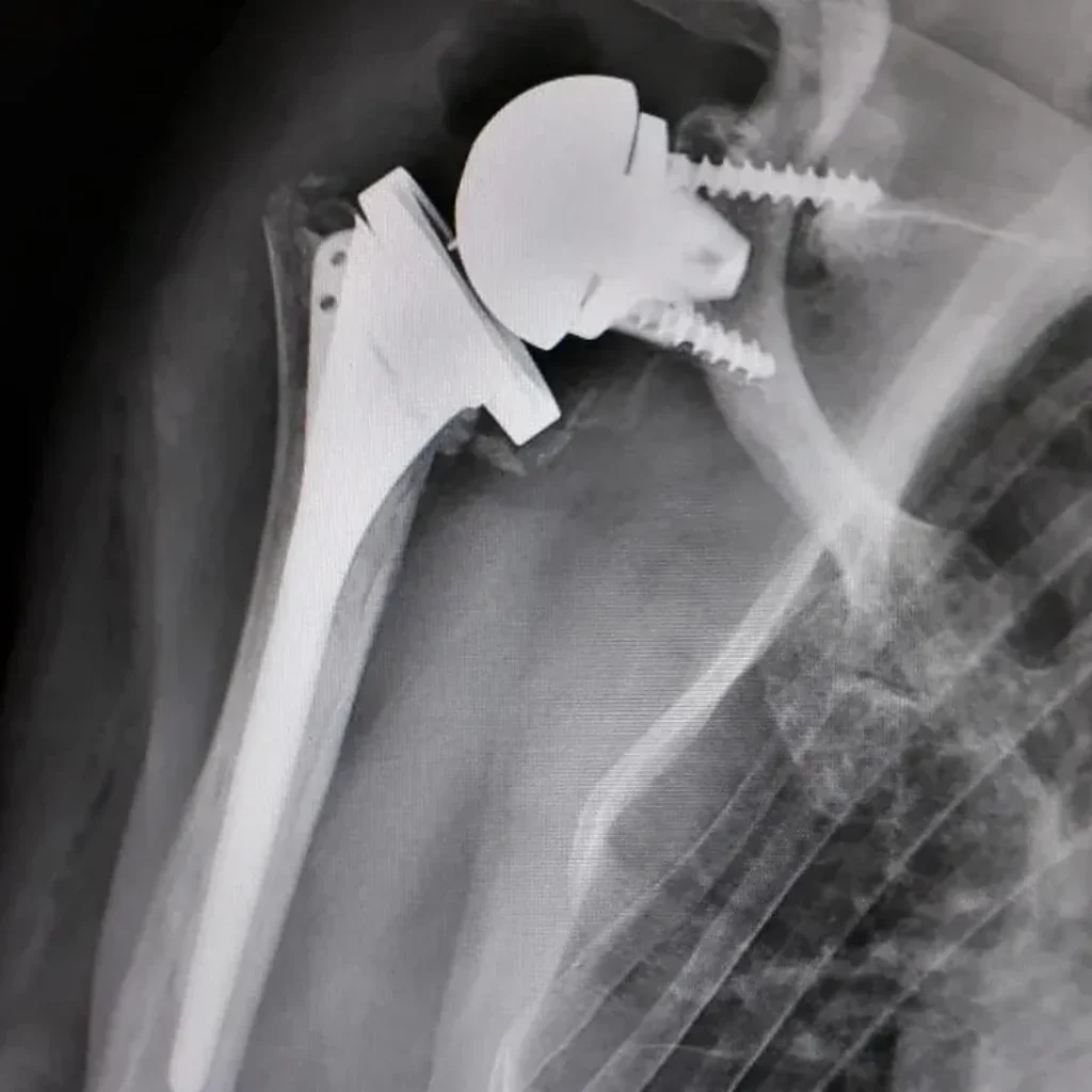 SHOULDER PROSTHESIS