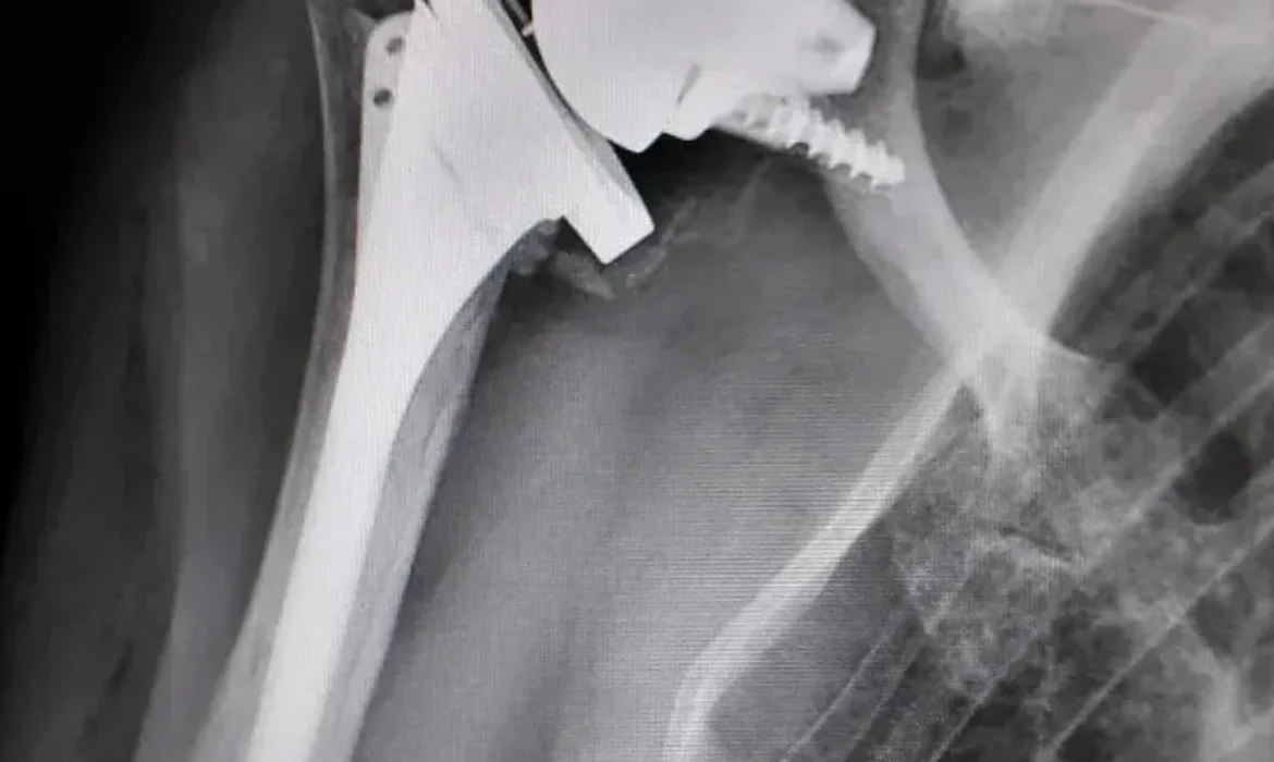SHOULDER PROSTHESIS