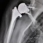 SHOULDER PROSTHESIS