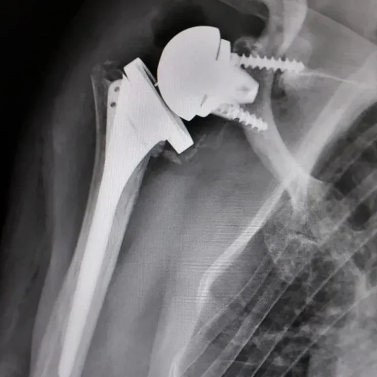 SHOULDER PROSTHESIS