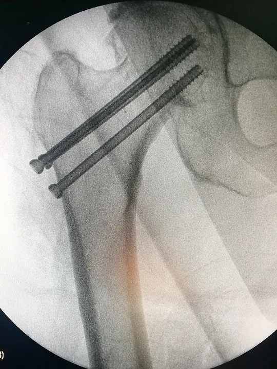 Vissage percutané d'une fracture non déplacée du col fémoral