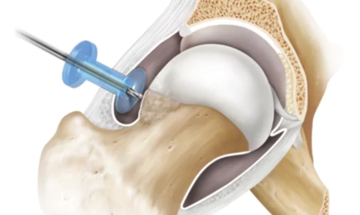 medium_hip-arthritis-femoral-acetabular-impingement-fai-arthroscopy-illLB1-0313-EN-879fd9a