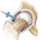 HIP ARTHROSCOPY