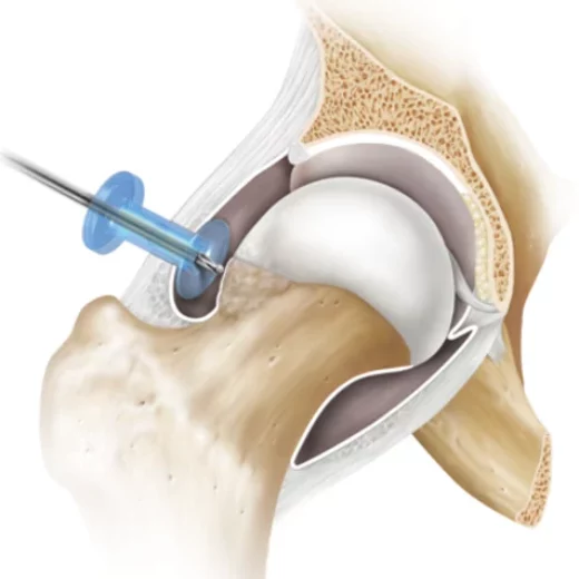 medium_hip-arthritis-femoral-acetabular-impingement-fai-arthroscopy-illLB1-0313-EN-879fd9a