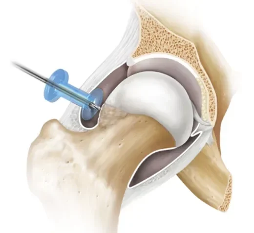 medium_hip-arthritis-femoral-acetabular-impingement-fai-arthroscopy-illLB1-0313-EN-879fd9a