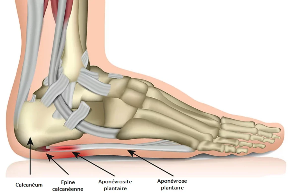 plantar-fasciitis-illustration-511e79