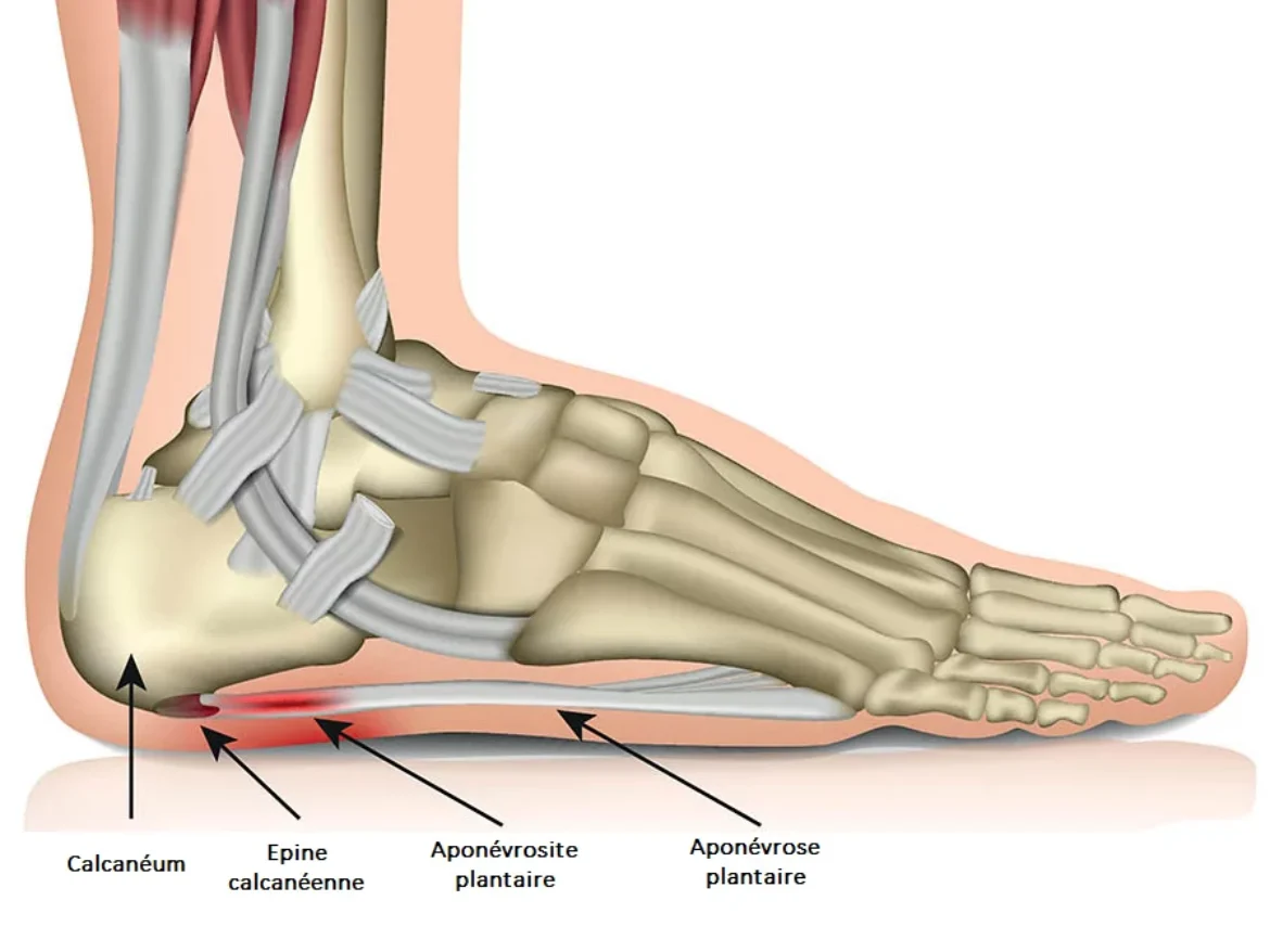 plantar-fasciitis-illustration-511e79