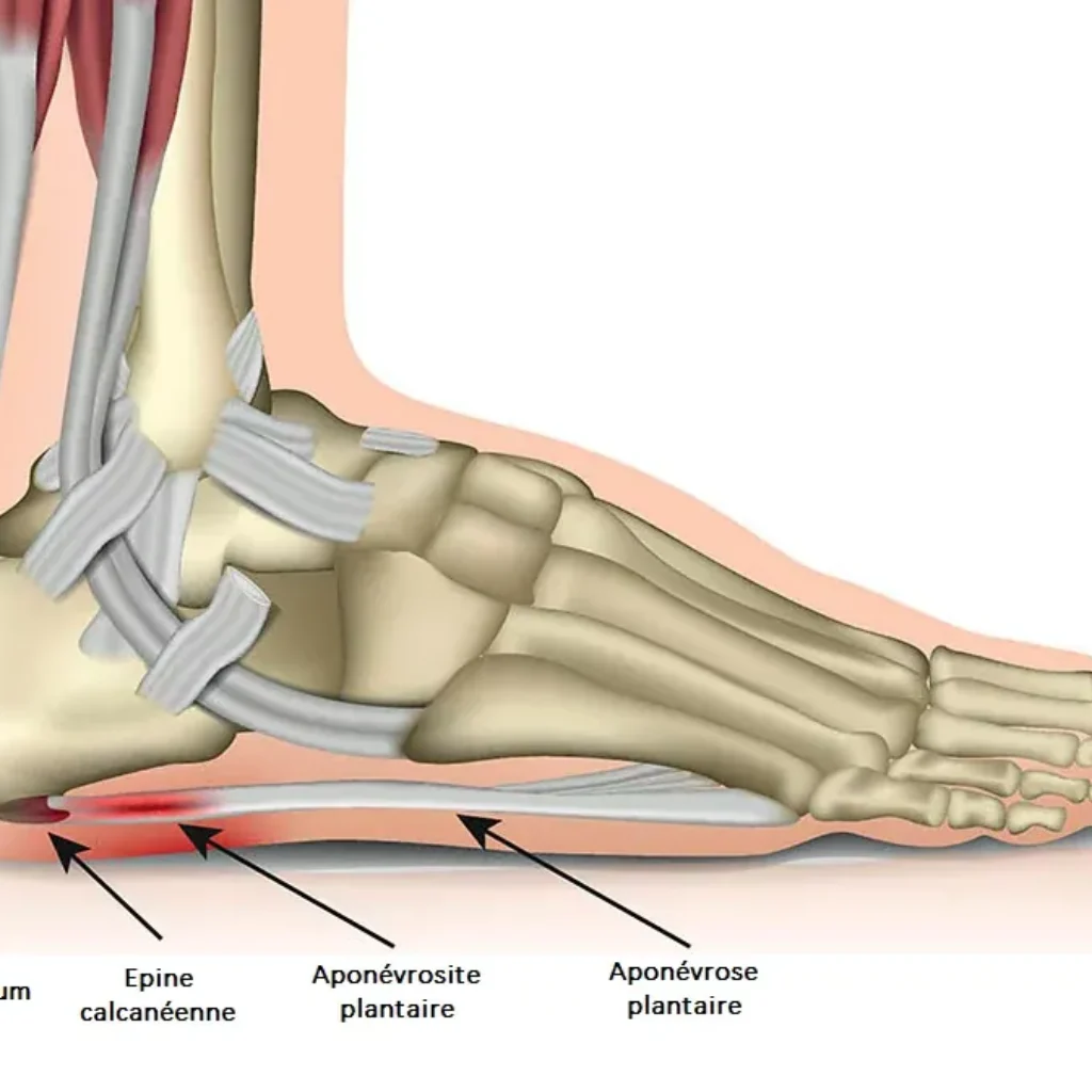 plantar-fasciitis-illustration-511e79