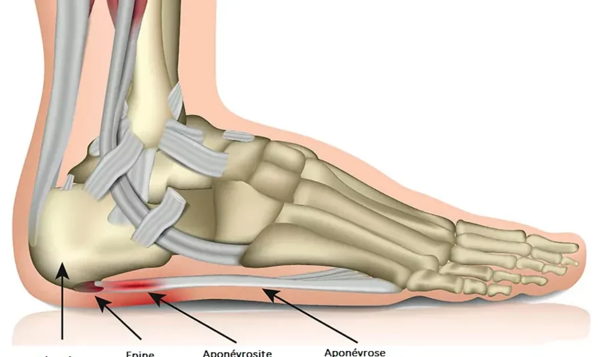 plantar-fasciitis-illustration-511e79