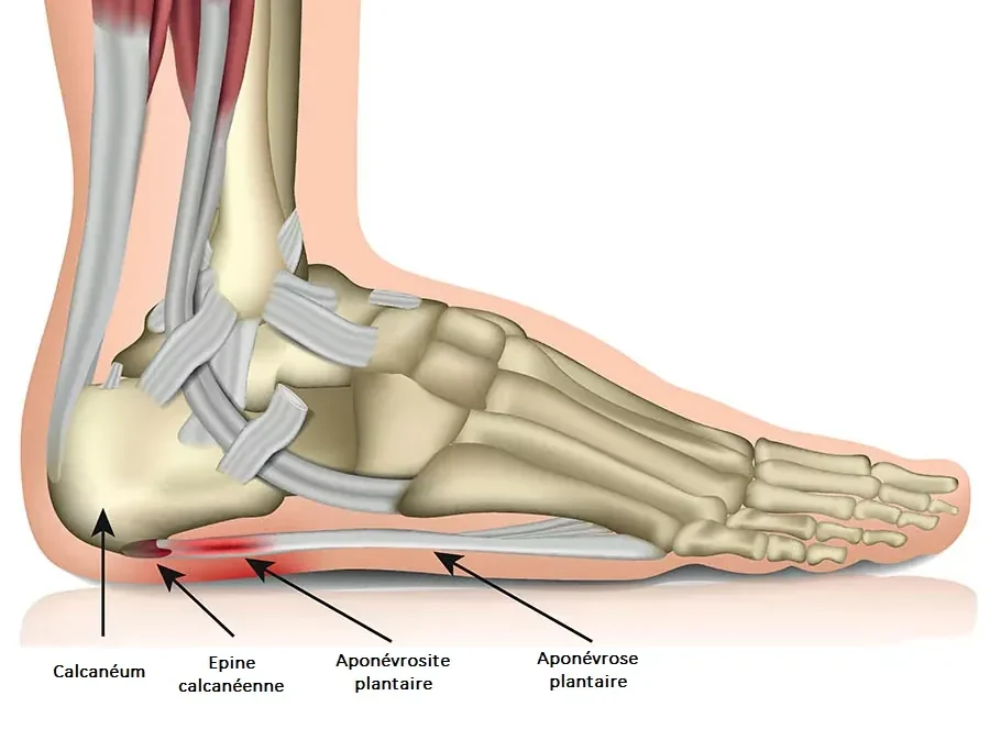 plantar-fasciitis-illustration-511e79
