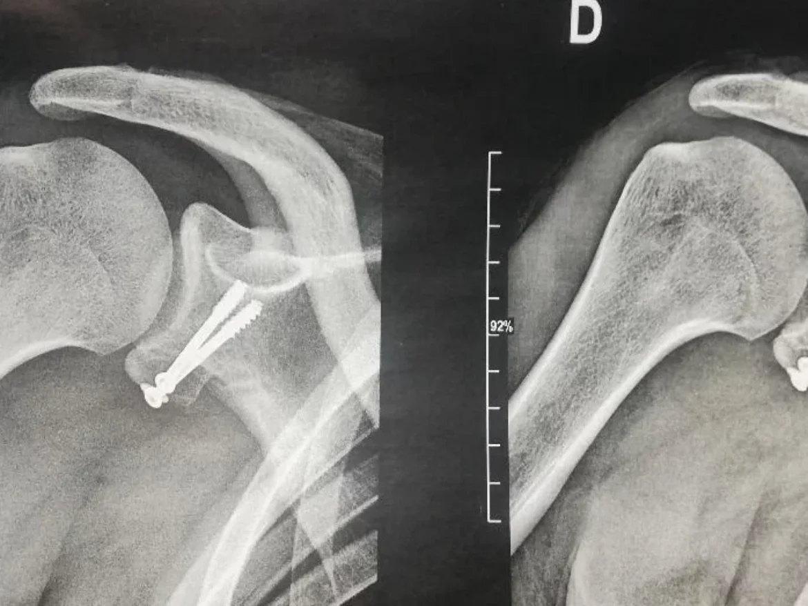 INSTABILITÉ DE L&rsquo;ÉPAULE