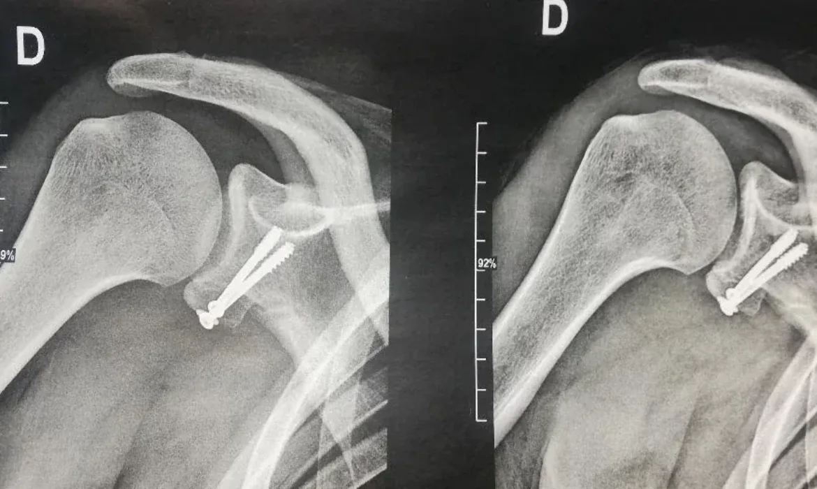 SHOULDER INSTABILITY