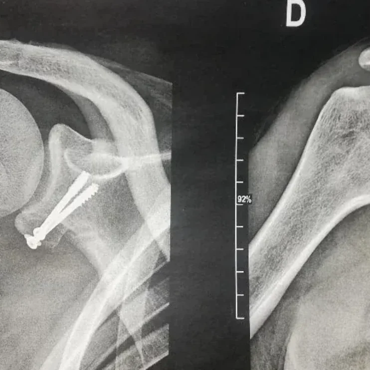 SHOULDER INSTABILITY
