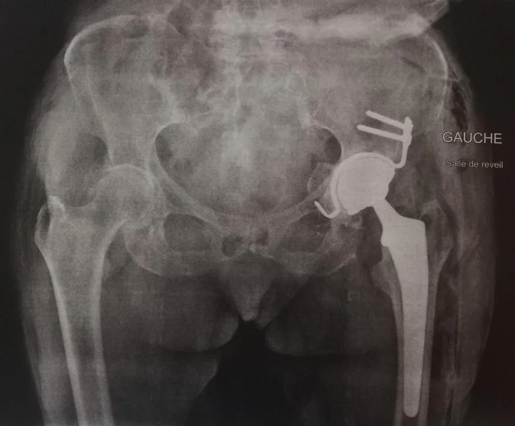 Radiographie après reconstruction du cotyle pour restituer le centre de rotation de l'articulation