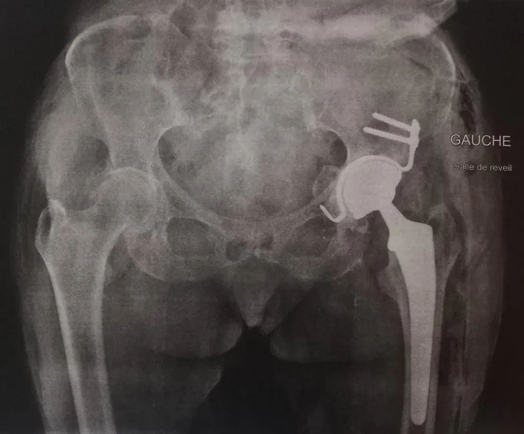 Radiographie après reconstruction du cotyle pour restituer le centre de rotation de l'articulation