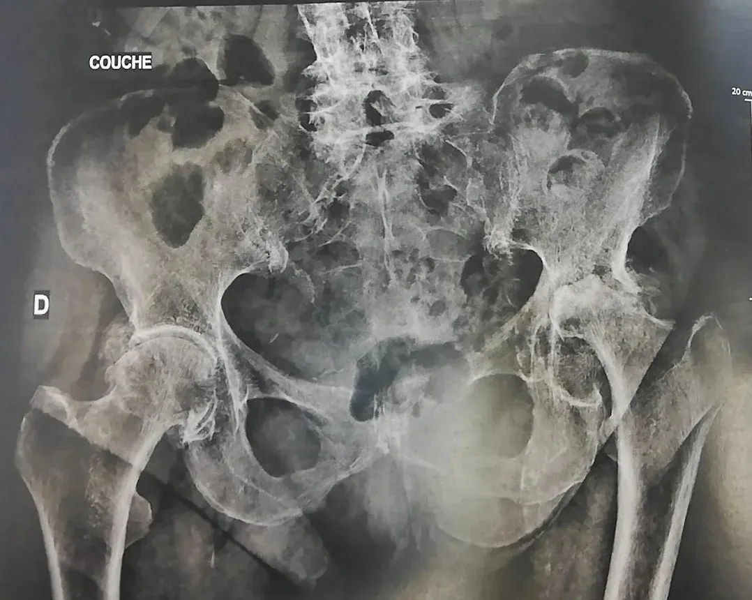 Parfois l'articulation est tellement détruite par l'arthrose qu'une reconstruction osseuse est nécessaire.