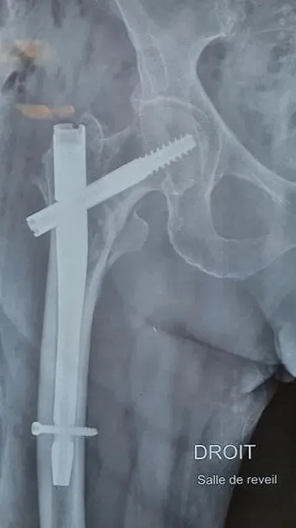 Ostéosynthèse d'une fracture per-trochantérienne par clou gamma