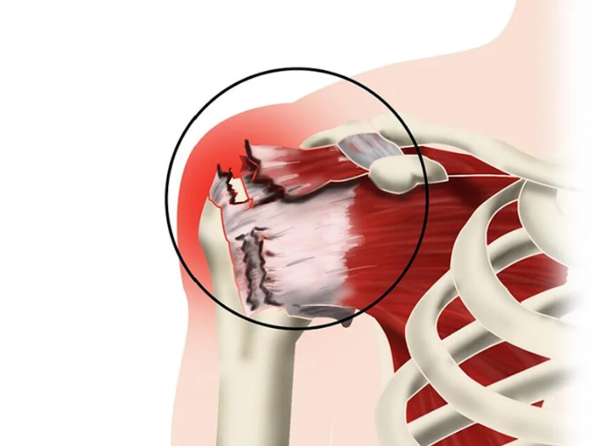 RUPTURE DE LA COIFFE DES ROTATEURS