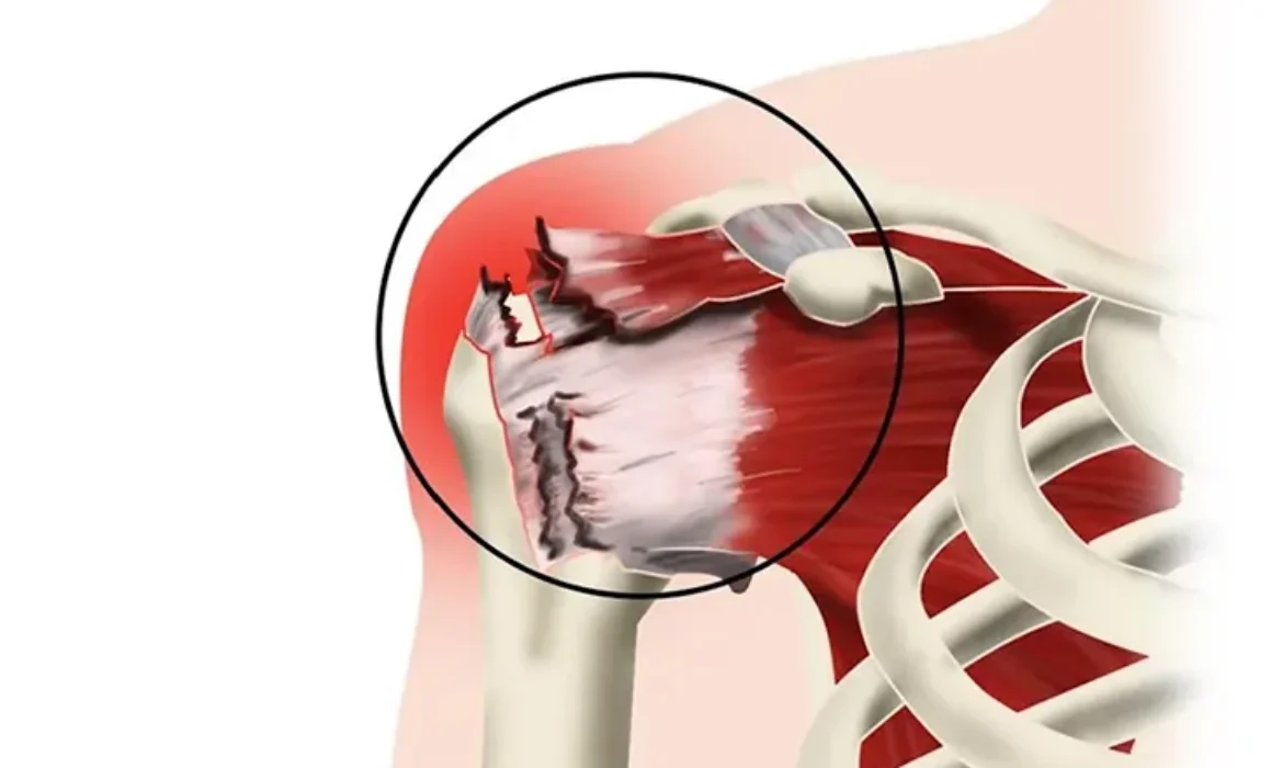 ROTATOR CUFF TEAR
