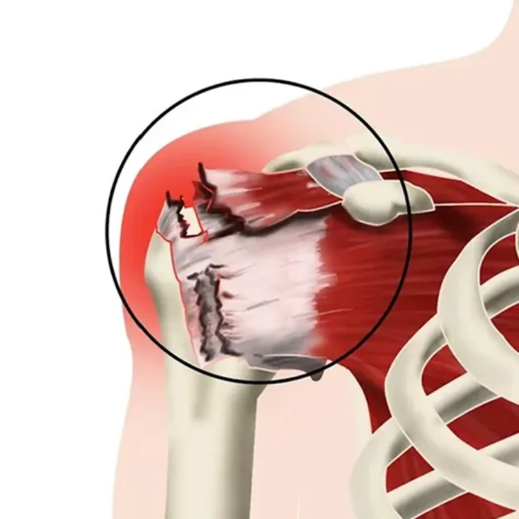 ROTATOR CUFF TEAR