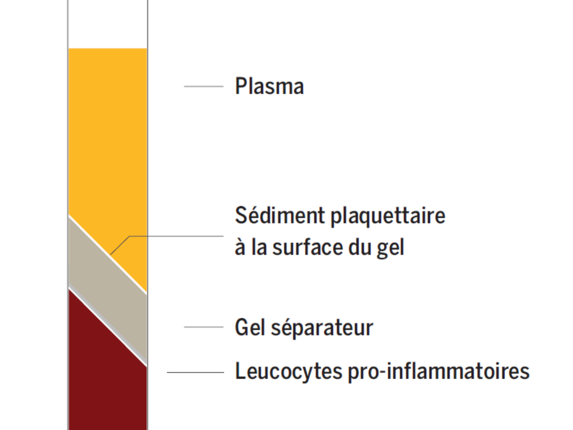 Infiltrations de PRP