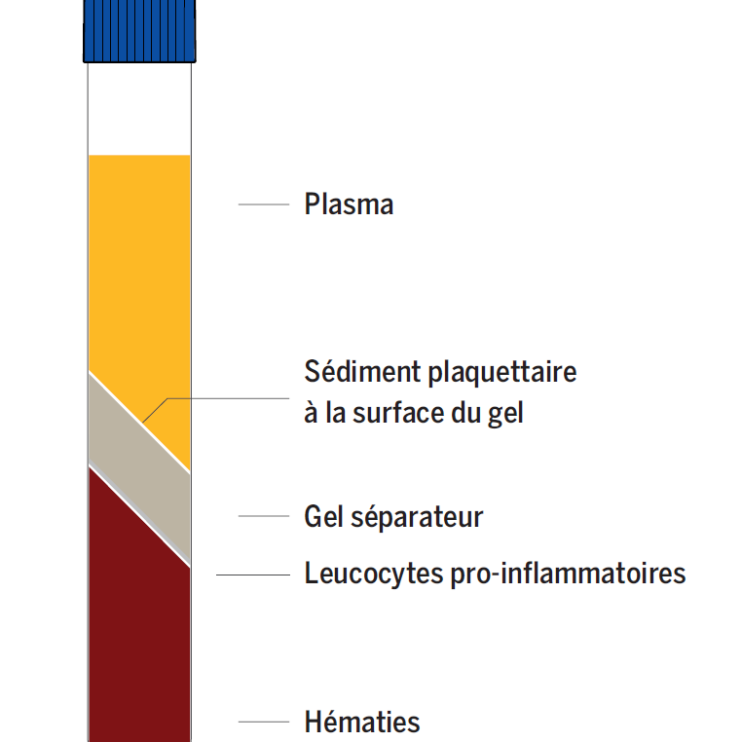Infiltrations de PRP