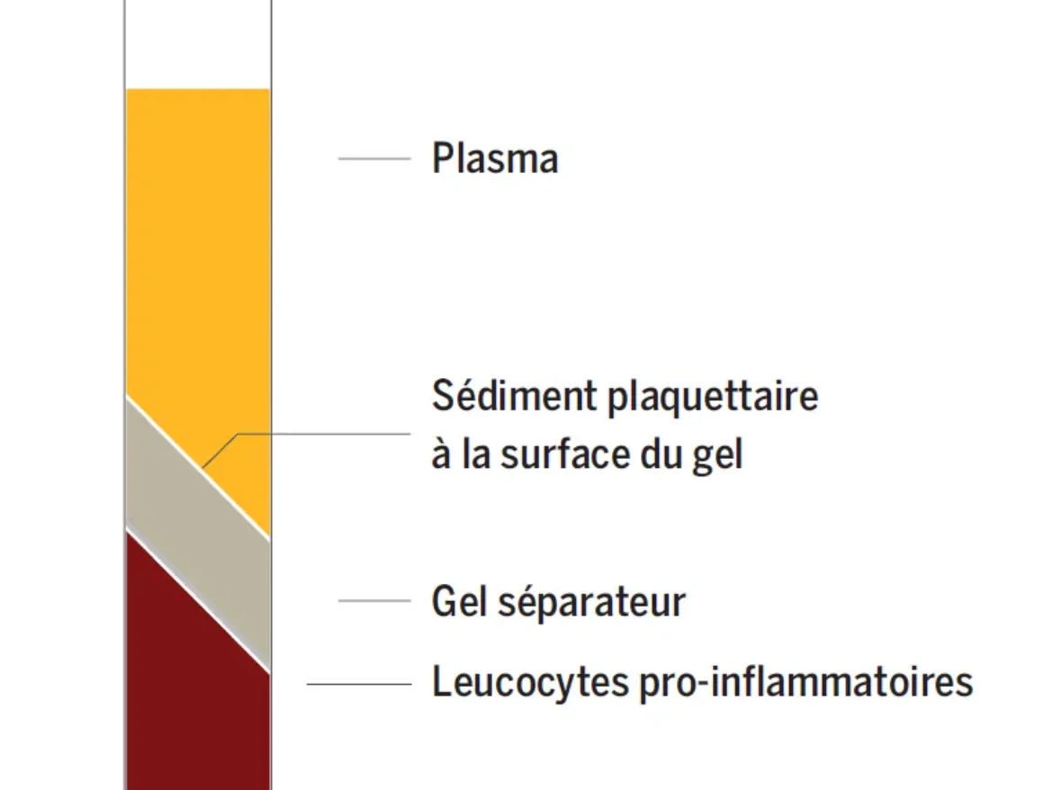 Infiltrations de PRP
