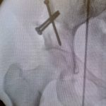 Préserver la hanche : Comprendre l’ostéotomie périacétabulaire (OPA)