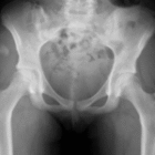 Ostéotomie périacétabulaire (OPA)