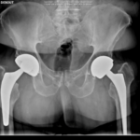 Reprise de prothèse totale de hanche