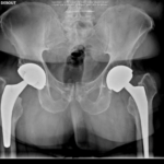 Reprise de prothèse totale de hanche