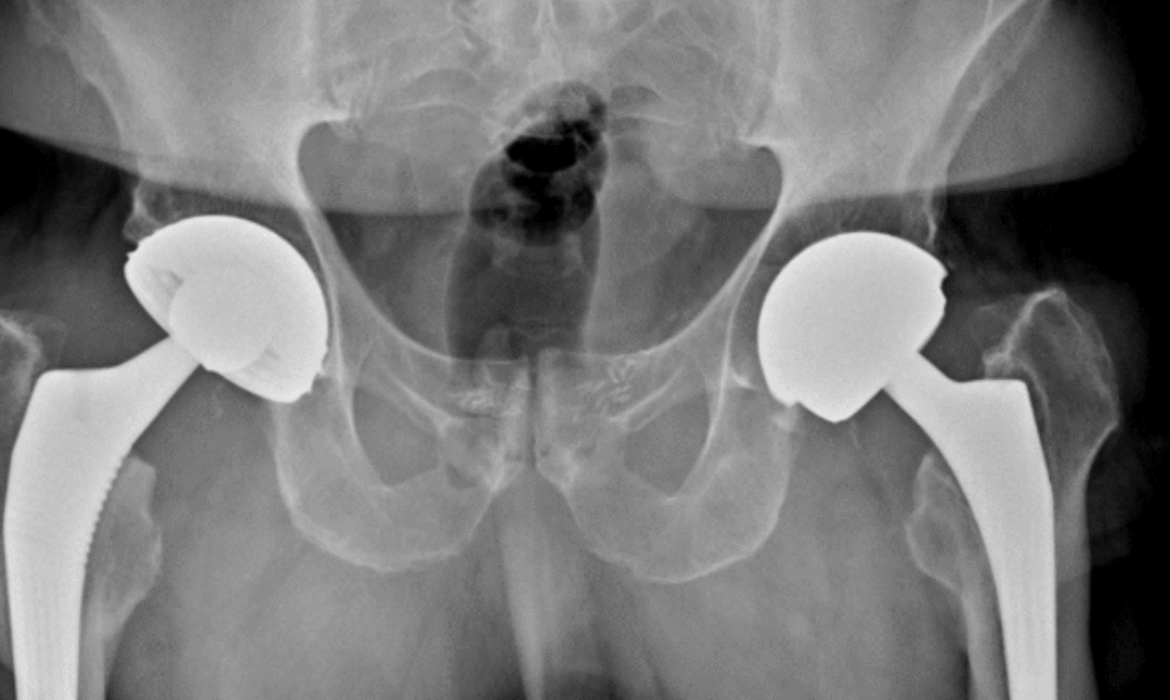 Reprise de prothèse totale de hanche