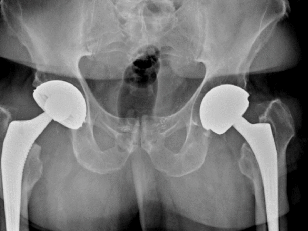 Reprise de prothèse totale de hanche