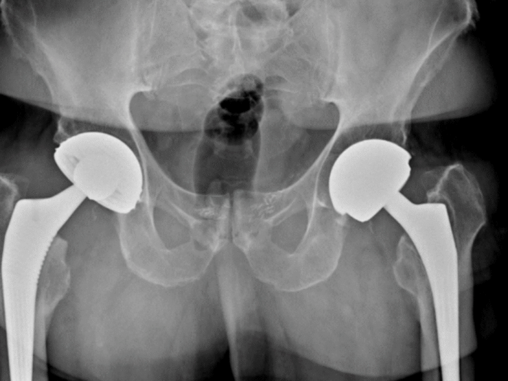 Reprise de prothèse totale de hanche