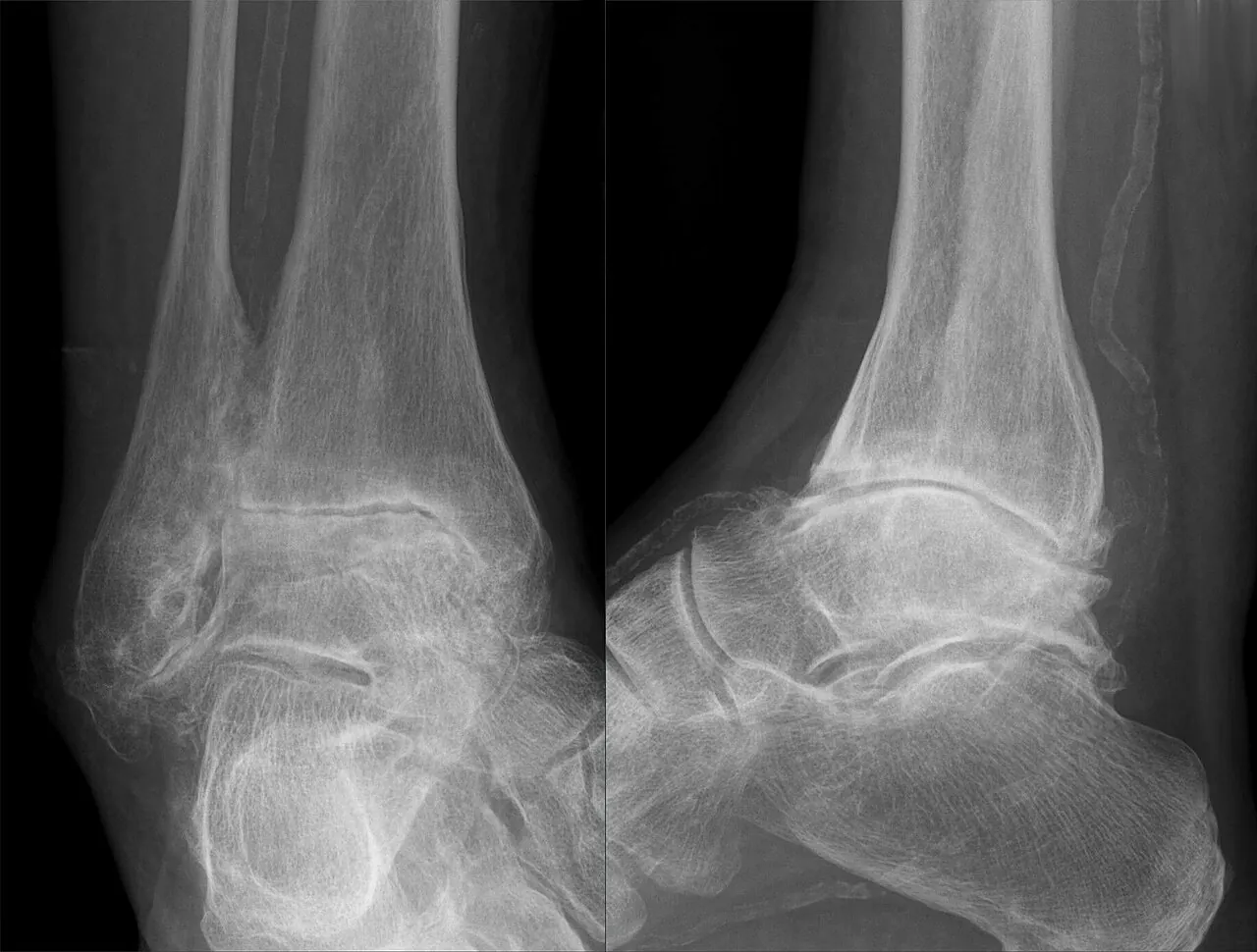 Radiographie de la cheville montrant une arthrose sévère : interligne articulaire pincé et dôme du talus aplati